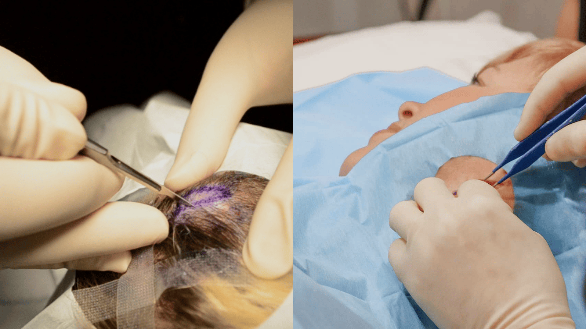 Biopsy of Pilar and Sebaceous Cysts