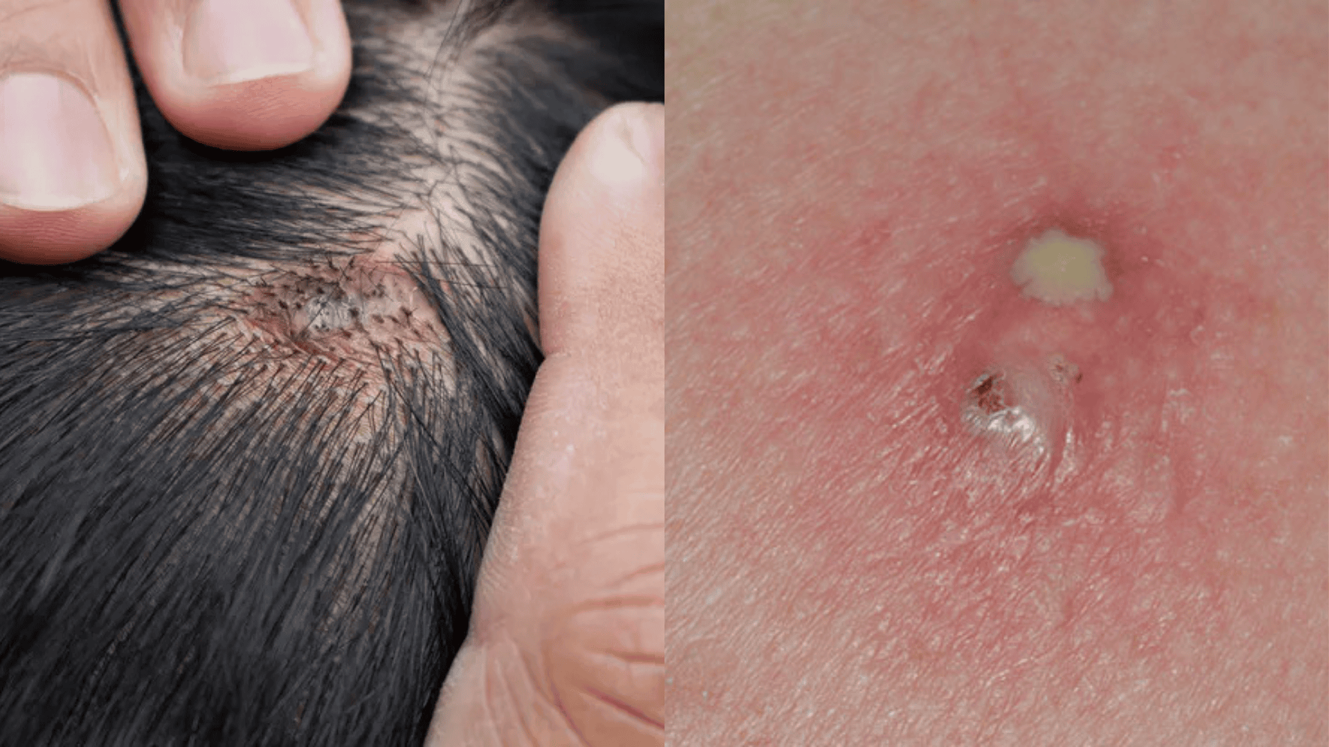 Infection check of Pilar and Sebaceous Cysts