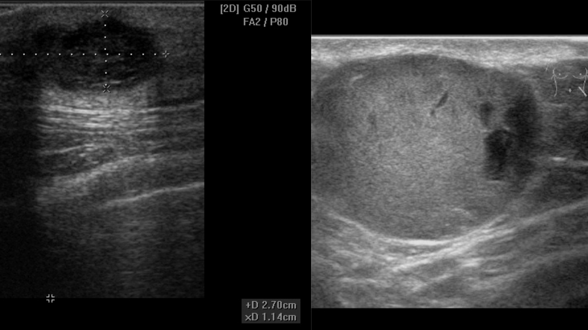 Ultrasound of Pilar and Sebaceous Cysts