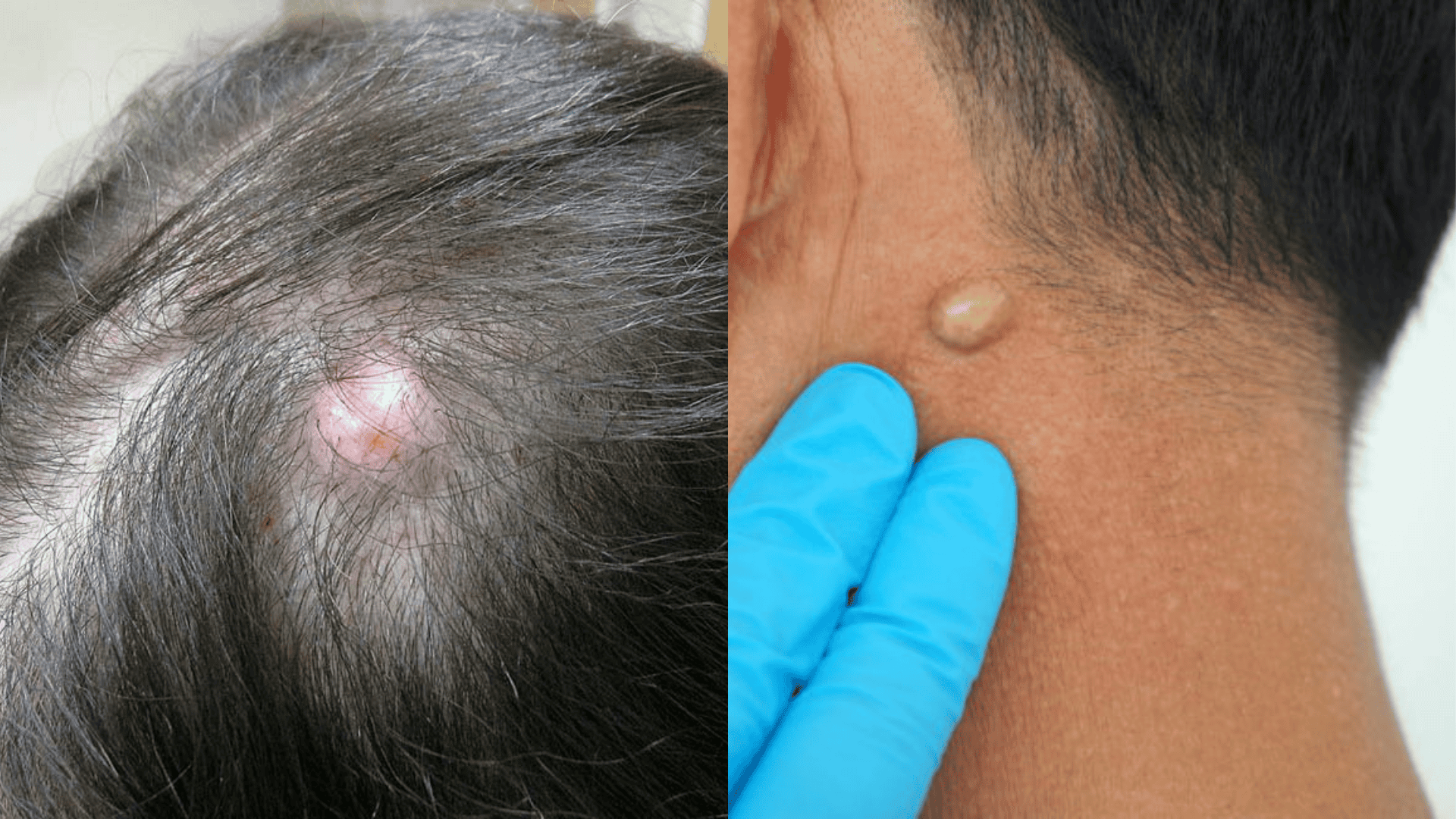 pilar cyst vs sebaceous cyst