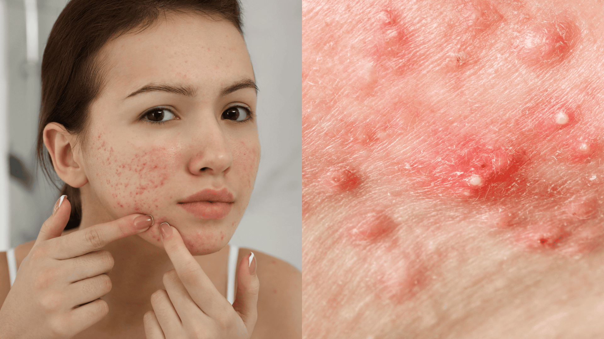 signs of retinol purge acne breakouts