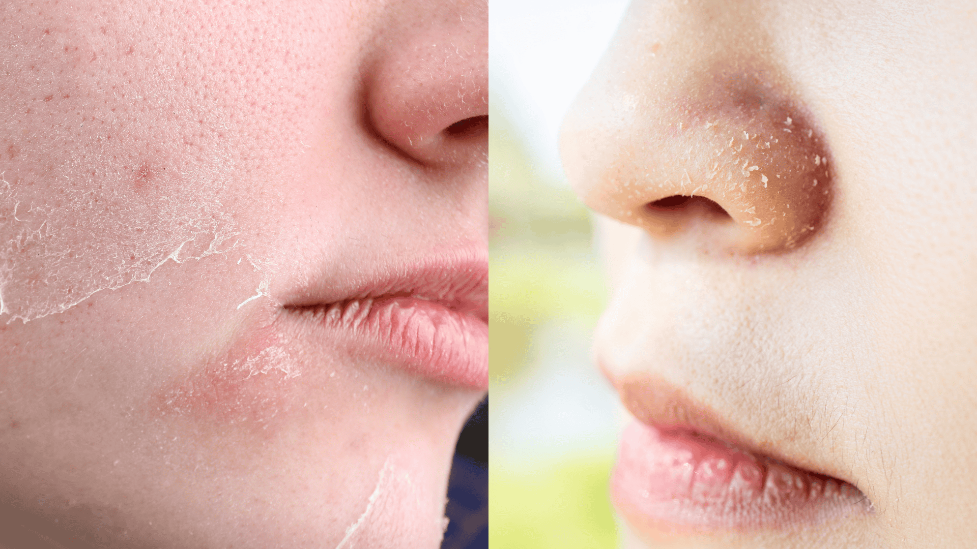 signs of retinol purge flaky skin