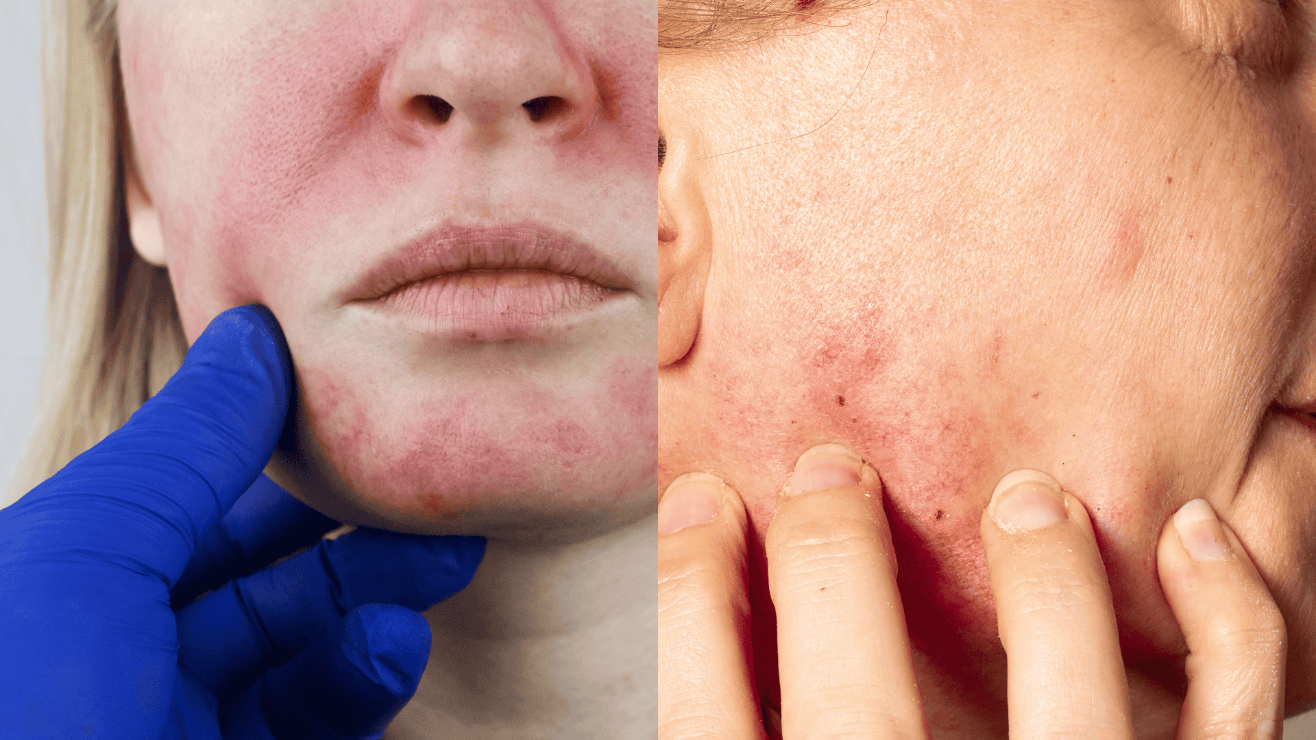 signs of retinol purge slight redness