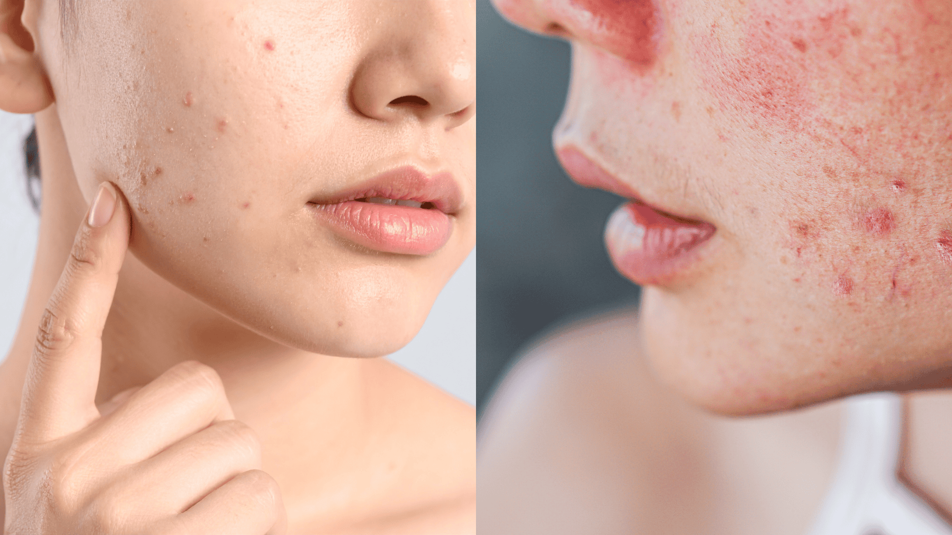 signs of retinol purge small pimples