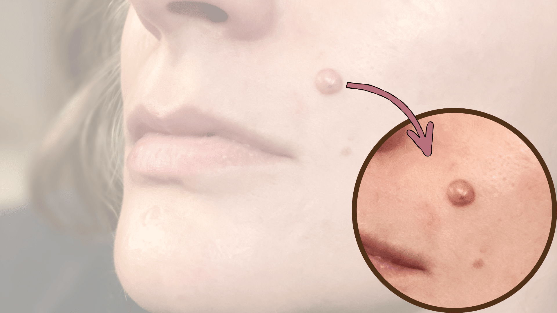 beauty mark removal reddit