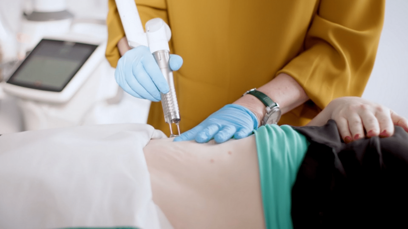 How Does the Stretch Mark Removal Laser Work?